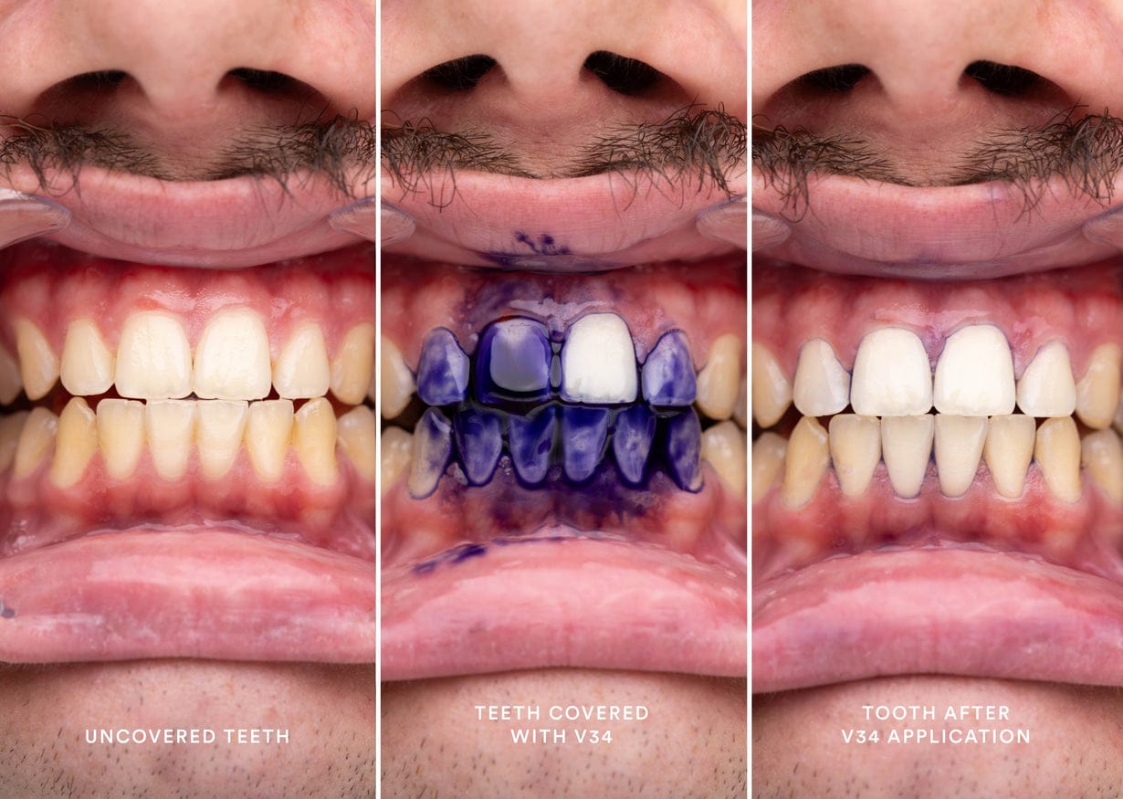 Dentist-Approved Teeth Whitening Powder